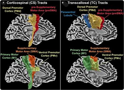 Transcallosal and Corticospinal White Matter Disease and Its Association With Motor Impairment in Multiple Sclerosis